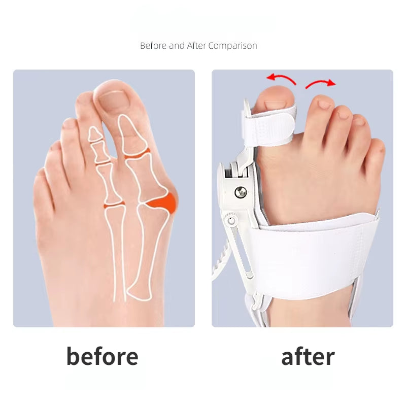Revolutionary Hallux Valgus Corrector: Bunion Relief and Toe Separation for Ultimate Foot Comfort